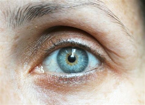 kahverengi göz mavi göz ameliyatı